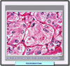 Imagen histolgica de un fecromocitoma