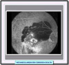 Fotograma de angiografa fluorescena de una neovascularizacin coroidea oculta