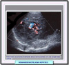 Ultrasonografía de un hemangioendotelioma hepático