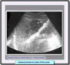 Radiografía de hemangioendotelioma epitepiteloide
