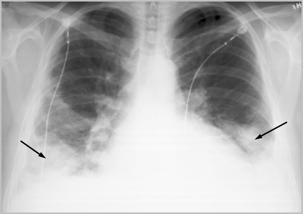 embolia pulmonar masiva