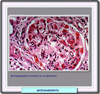Microangiopatías glomerulares