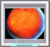 Fotografía de fondo de ojo de un edema macular difuso