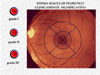 Clasificación del edema macular