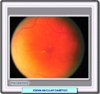 Edema macular. Fondo de ojo despus de un tratamiento con lser