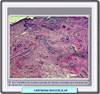 Histología de un carcinoma basocelular morfeamórfico