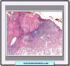 Histologa de un carcinoma espinocelualr de grado I
