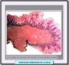 Carcinoma verrugoso de la vulva