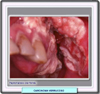 Carcinoma verrugoso de la mucosa oral