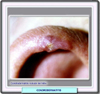 Imagen aumentada de una condrodermatitis nodula
