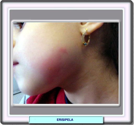 Fotografía de una niña con erisipela en la cara