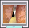 Manchas de vitilifo en las piernas