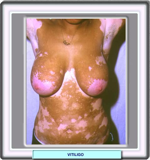 vitiligo06.jpg