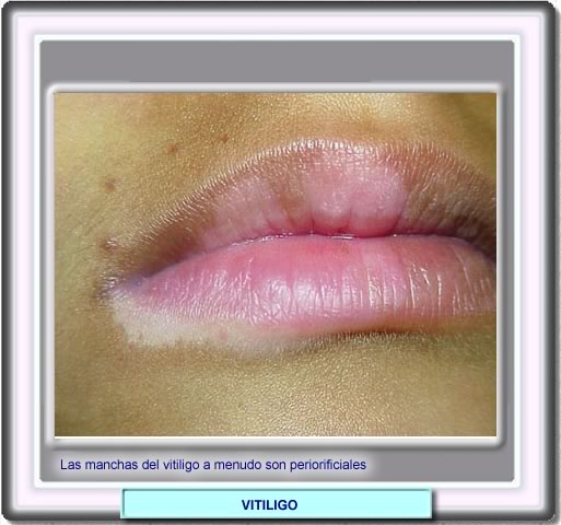 Mculas de vitilico en los labios y perioralmente