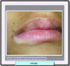 Vitiligo en los labios