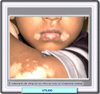 Tratamiento del vitiligo en los niños