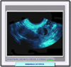 Ultrasonografia transvaginal