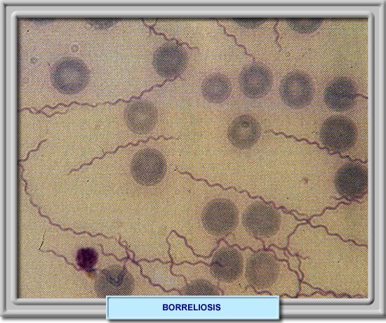 Frotis de sangre periférica mostrando Borrelias