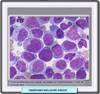 Anemia refractactaria con exceso de blastos en transformacin