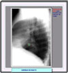 Imagen radiolgica de una hernia paraesofgica