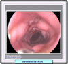Colonoscopia en la enfermedad de crohn