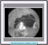 Fotograma de angiografía fluoresceína de una neovascularización coroidea clásica