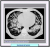 Infiltrados pulmonares en el síndrome de ácido retinoico
