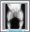 Radiografía del síndrome de Ellis-Creveld