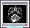 RM de un neurocitoma extraventricular