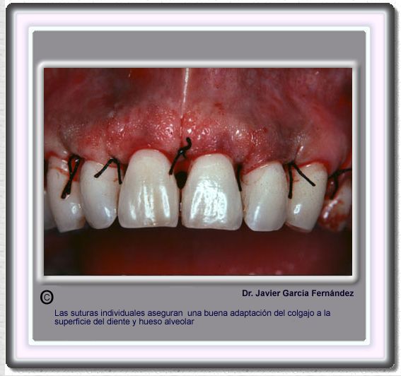 Atlas Of Surgical Techniques In Periodontics. Chapter III.